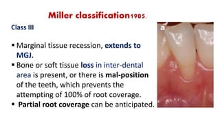 New Miller Classification Art of predicting root coverage in localized gingival recession | PDF