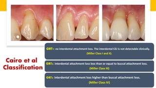 Art of predicting root coverage in localized gingival recession | PDF