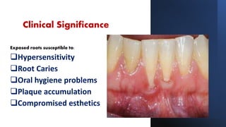 Art of predicting root coverage in localized gingival recession | PPT