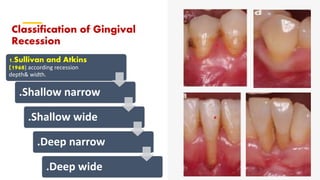 Art of predicting root coverage in localized gingival recession | PPT