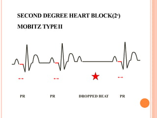 SECOND DEGREE HEART BLOCK(2º)
MOBITZ TYPEII
PR PR DROPPED BEAT PR
 