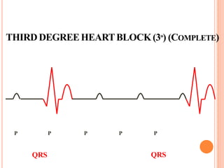 THIRDDEGREEHEARTBLOCK(3º) (COMPLETE)
P P P P P
QRS QRS
 