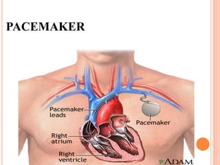 PACEMAKER
 