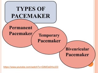 TYPES OF
PACEMAKER
Permanent
Pacemaker
Bivenricular
Pacemaker
https://www.youtube.com/watch?v=GIMOa0HvLE0
 