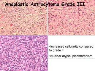 •Increased cellularity compared
to grade II
•Nuclear atypia, pleomorphism
Anaplastic Astrocytoma Grade III
 