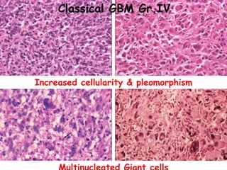 Increased cellularity & pleomorphism
Classical GBM Gr.IV
 