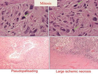 Mitosis
Large ischemic necrosisPseudopallisading
 