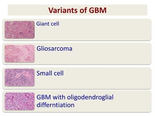 Variants of GBM
Giant cell
Gliosarcoma
Small cell
GBM with oligodendroglial
differntiation
 