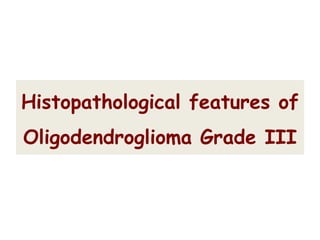 Histopathological features of
Oligodendroglioma Grade III
 
