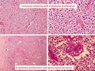 Increased cellularity with endothelial proliferation
Endothelial proliferation with glomeruloid formation
 