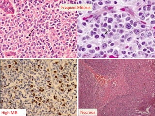 High MIB
Frequent Mitosis
Necrosis
 