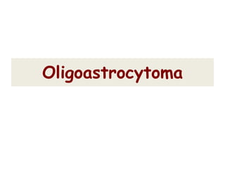 Oligoastrocytoma
 