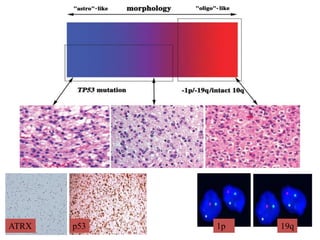 p53 1p 19qATRX
 