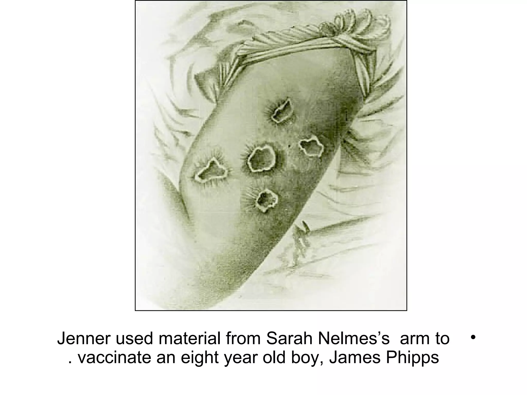 •Jenner used material from Sarah Nelmes’s arm to
vaccinate an eight year old boy, James Phipps.
 