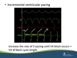 How to perform an ep study and diagnostic pacing during sinus rhythm | PPTX