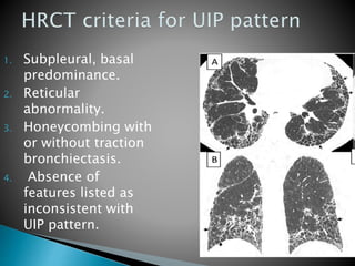 1. Subpleural, basal
predominance.
2. Reticular
abnormality.
3. Honeycombing with
or without traction
bronchiectasis.
4. Absence of
features listed as
inconsistent with
UIP pattern.
 