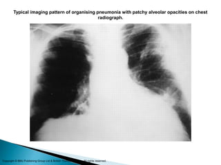 Typical imaging pattern of organising pneumonia with patchy alveolar opacities on chest
radiograph.
Copyright © BMJ Publishing Group Ltd & British Thoracic Society. All rights reserved.
 