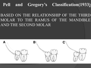 Pell and Gregory’s Classification(1933)
BASED ON THE RELATIONSHIP OF THE THIRD
MOLAR TO THE RAMUS OF THE MANDIBLE
AND THE SECOND MOLAR
 
