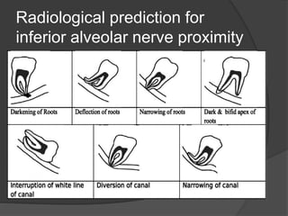 Radiological prediction for
inferior alveolar nerve proximity
 