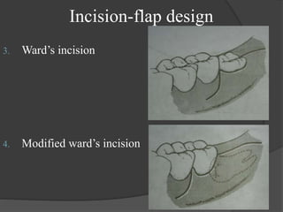 Incision-flap design
3. Ward’s incision
4. Modified ward’s incision
 