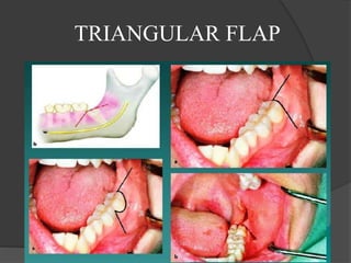TRIANGULAR FLAP
 