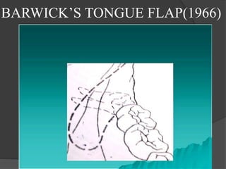 BARWICK’S TONGUE FLAP(1966)
 