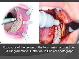 Exposure of the crown of the tooth using a round bur.
a Diagrammatic illustration. b Clinical photograph
 