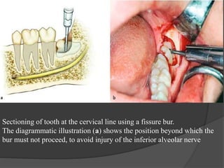 Sectioning of tooth at the cervical line using a fissure bur.
The diagrammatic illustration (a) shows the position beyond which the
bur must not proceed, to avoid injury of the inferior alveolar nerve
 