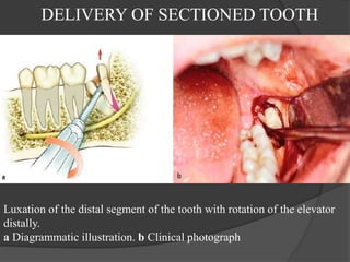 DELIVERY OF SECTIONED TOOTH
Luxation of the distal segment of the tooth with rotation of the elevator
distally.
a Diagrammatic illustration. b Clinical photograph
 
