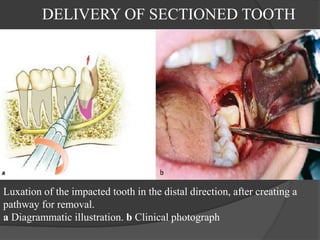 DELIVERY OF SECTIONED TOOTH
Luxation of the impacted tooth in the distal direction, after creating a
pathway for removal.
a Diagrammatic illustration. b Clinical photograph
 
