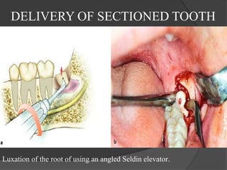 DELIVERY OF SECTIONED TOOTH
Luxation of the root of using an angled Seldin elevator.
 