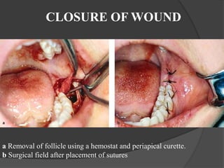 CLOSURE OF WOUND
a Removal of follicle using a hemostat and periapical curette.
b Surgical field after placement of sutures
 
