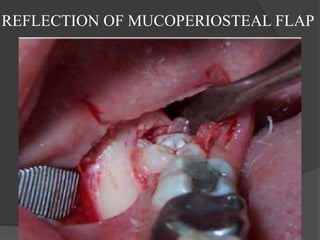 REFLECTION OF MUCOPERIOSTEAL FLAP
 
