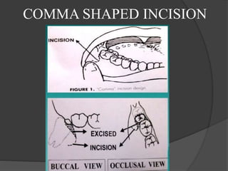 COMMA SHAPED INCISION
 