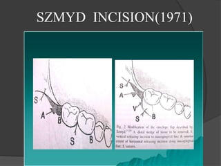 SZMYD INCISION(1971)
 