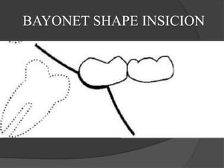 BAYONET SHAPE INSICION
 