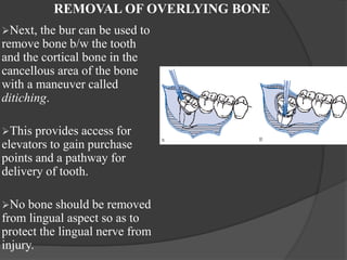 REMOVAL OF OVERLYING BONE
Next, the bur can be used to
remove bone b/w the tooth
and the cortical bone in the
cancellous area of the bone
with a maneuver called
ditiching.
This provides access for
elevators to gain purchase
points and a pathway for
delivery of tooth.
No bone should be removed
from lingual aspect so as to
protect the lingual nerve from
injury.
 