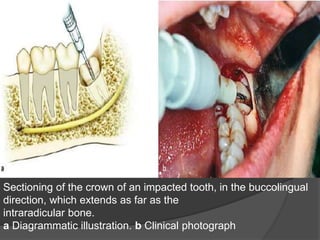 Sectioning of the crown of an impacted tooth, in the buccolingual
direction, which extends as far as the
intraradicular bone.
a Diagrammatic illustration. b Clinical photograph
 