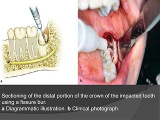 Sectioning of the distal portion of the crown of the impacted tooth
using a fissure bur.
a Diagrammatic illustration. b Clinical photograph
 