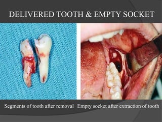 DELIVERED TOOTH & EMPTY SOCKET
Segments of tooth after removal Empty socket after extraction of tooth
 
