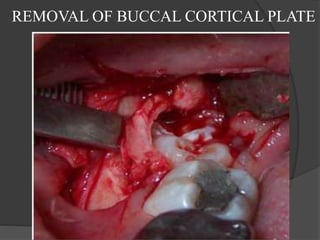 REMOVAL OF BUCCAL CORTICAL PLATE
 