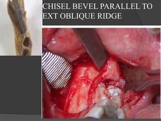 CHISEL BEVEL PARALLEL TO
EXT OBLIQUE RIDGE
 
