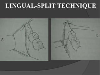 LINGUAL-SPLIT TECHNIQUE
 
