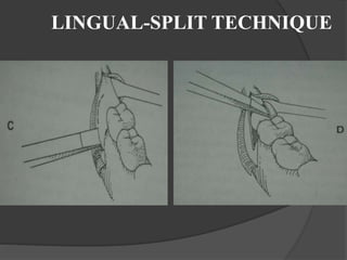 LINGUAL-SPLIT TECHNIQUE
 