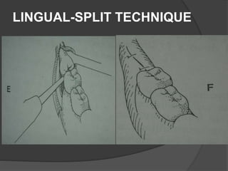 LINGUAL-SPLIT TECHNIQUE
 