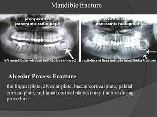Mandible fracture
Alveolar Process Fracture
the lingual plate, alveolar plate, buccal cortical plate, palatal
cortical plate, and labial cortical plate(s) may fracture during
procedure.
 
