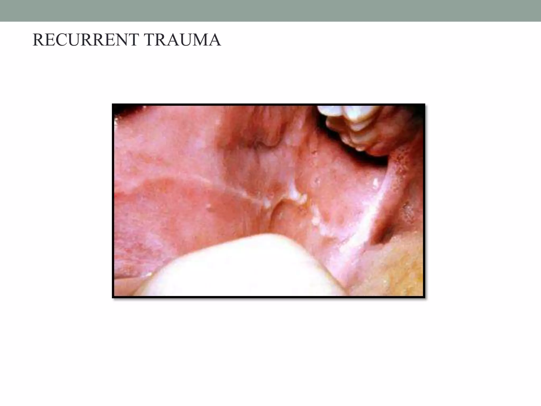 Impacted third molars | PPTX