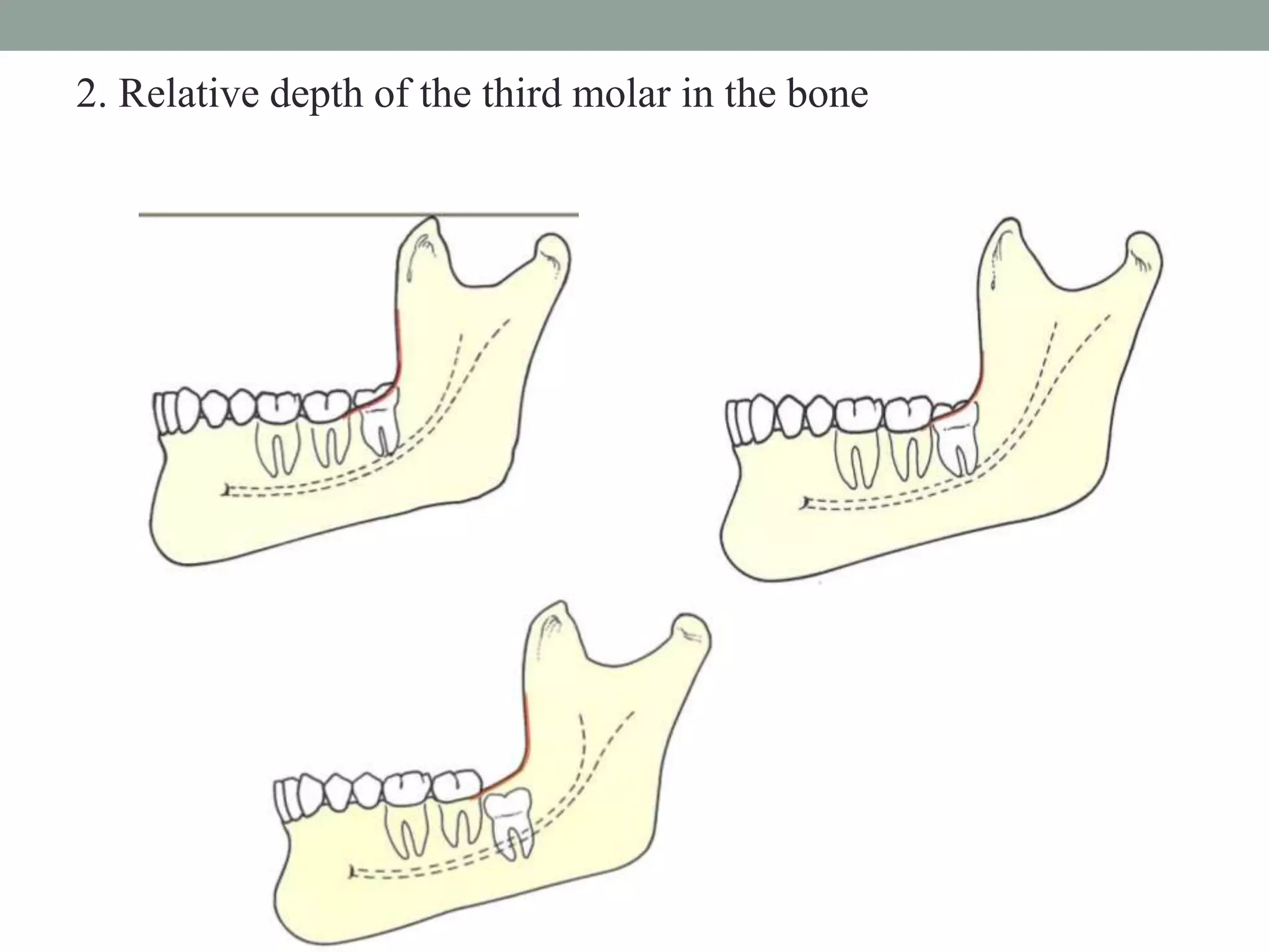 Impacted third molars | PPTX