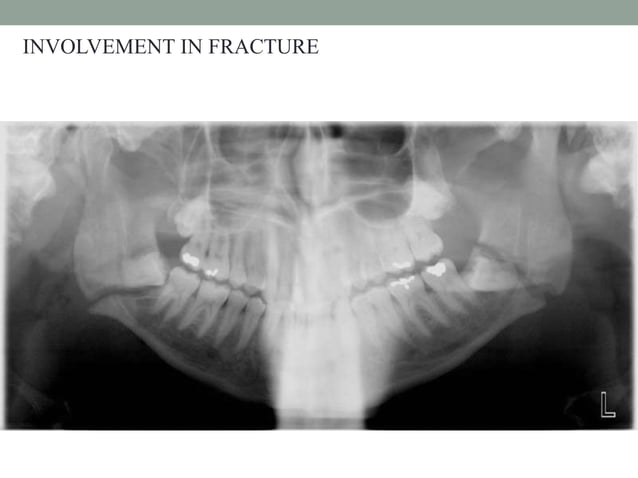 Impacted third molars | PPTX | Dental Health | Diseases and Conditions