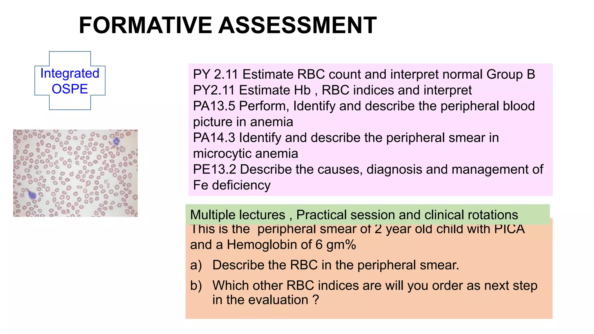 This is the peripheral smear of 2 year old child with PICA
and a Hemoglobin of 6 gm%
a) Describe the RBC in the peripheral smear.
b) Which other RBC indices are will you order as next step
in the evaluation ?
Integrated
OSPE
PY 2.11 Estimate RBC count and interpret normal Group B
PY2.11 Estimate Hb , RBC indices and interpret
PA13.5 Perform, Identify and describe the peripheral blood
picture in anemia
PA14.3 Identify and describe the peripheral smear in
microcytic anemia
PE13.2 Describe the causes, diagnosis and management of
Fe deficiency
Multiple lectures , Practical session and clinical rotations
FORMATIVE ASSESSMENT
 